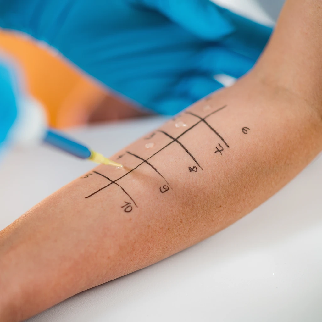 Allergiediagnostik - Praxis f&uuml;r Lungenheilkunde Dr. Selbig &ndash; Lungenarzt Ansbach